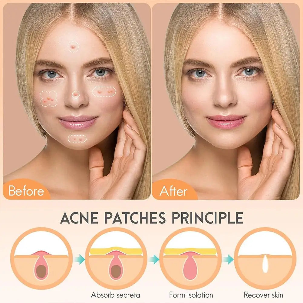 Lumiére Pimple Patches for Acne & Blemishes