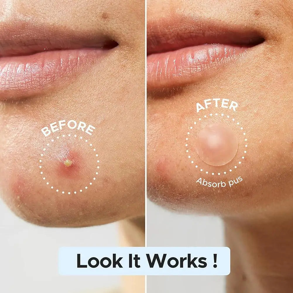 Lumiére Pimple Patches for Acne & Blemishes