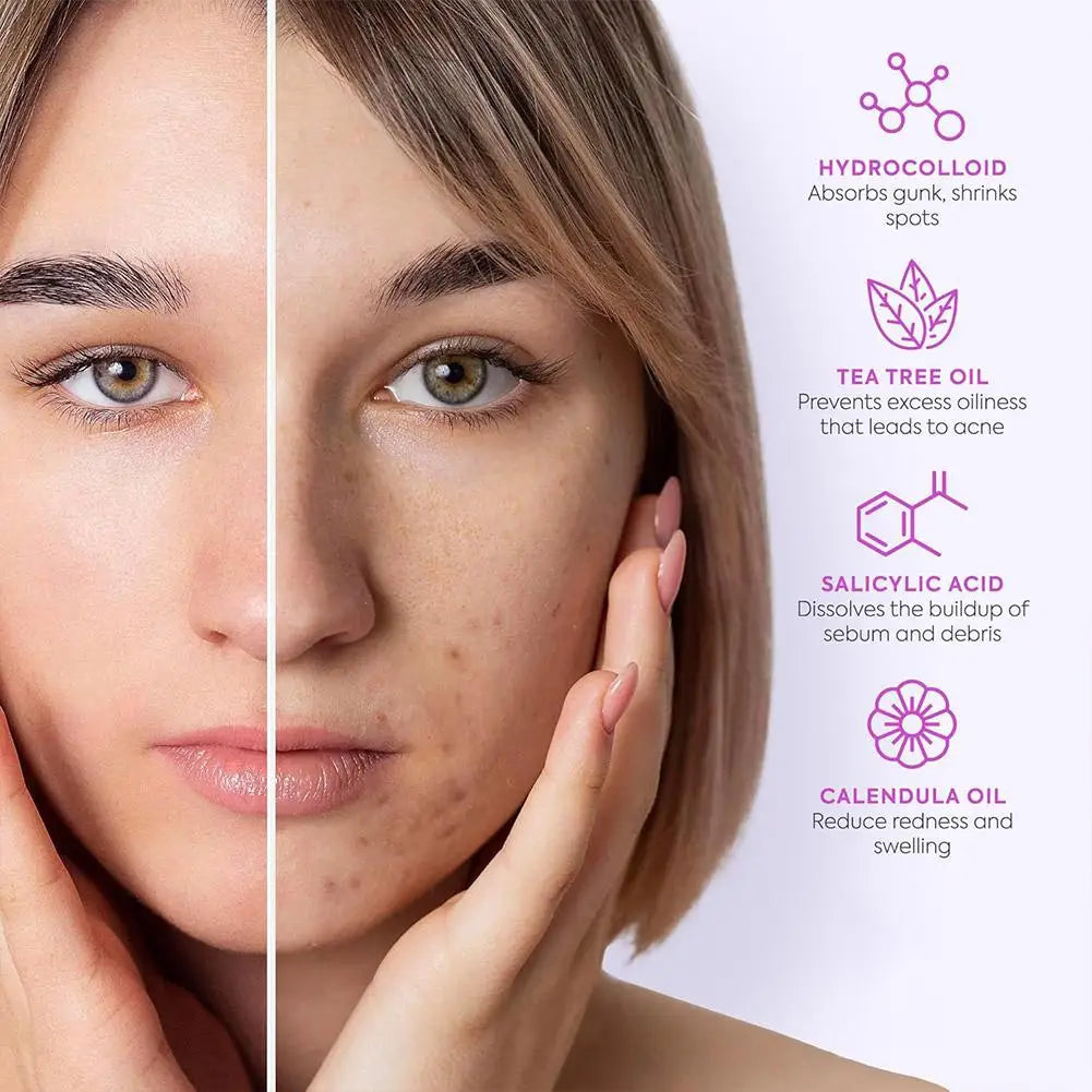 Lumiére Pimple Patches for Acne & Blemishes